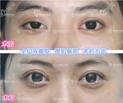 孟強(qiáng)雙眼皮修復(fù)案例 孟強(qiáng)雙眼皮修復(fù)案例