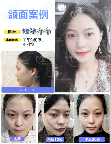 這四張下頜角截骨+3D顴骨縮小對比照片出自重慶時(shí)光