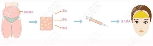 眉間紋填充脂肪手術(shù)過(guò)程 眉間紋填充脂肪手術(shù)過(guò)程