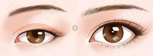 雙眼皮提肌手術(shù)效果 雙眼皮提肌手術(shù)效果