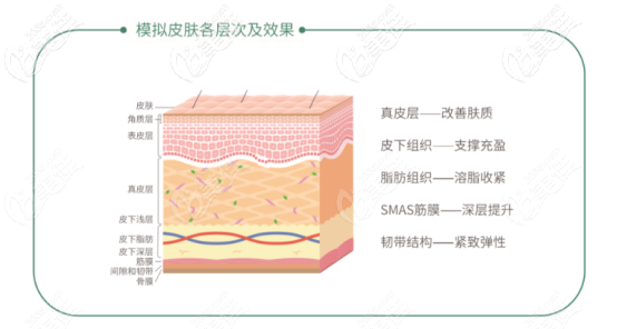 面部提升線“緊戀”