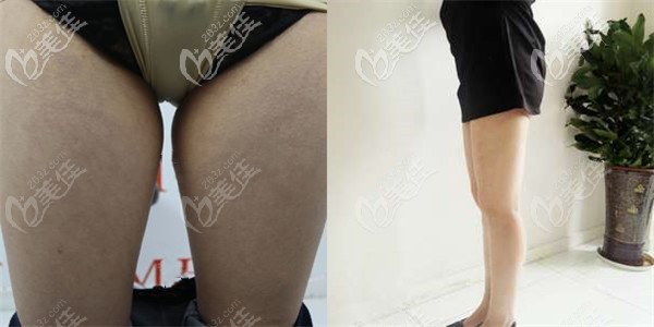 在美貝爾做大腿吸脂術(shù)前術(shù)后對(duì)比