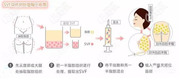 芘麗芙貴美人做SVF自體脂肪填充臉頰