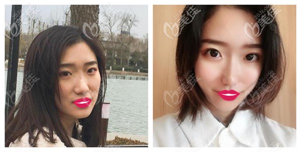 石家莊芘麗芙貴美人做SVF自體脂肪填充臉頰案例