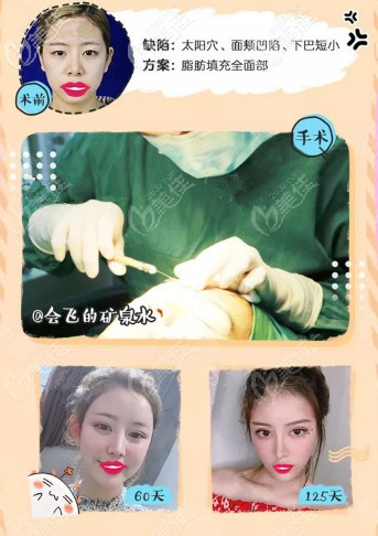 面容管家做SVF自體脂肪填充臉頰案例