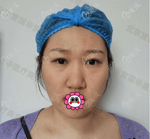 我做外切鼻翼縮小術(shù)前 我做外切鼻翼縮小術(shù)前