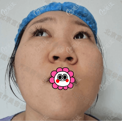 術(shù)前左右鼻翼不均勻的樣子 術(shù)前左右鼻翼不均勻的樣子