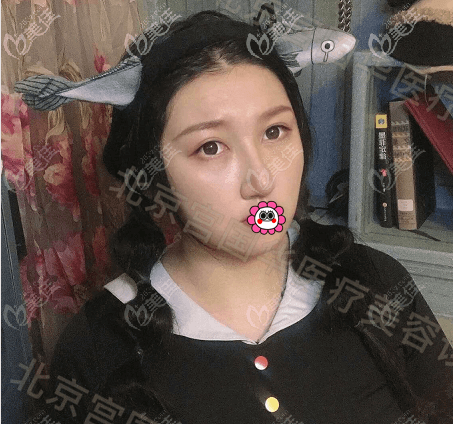 在北京宮國(guó)華醫(yī)療美容做鼻翼縮小快3個(gè)月的樣子 在北京宮國(guó)華醫(yī)療美容做鼻翼縮小快3個(gè)月的樣子