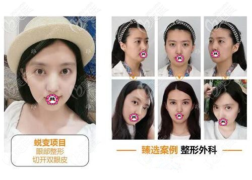 沈陽百嘉麗劉醫(yī)割雙眼皮真人案例圖