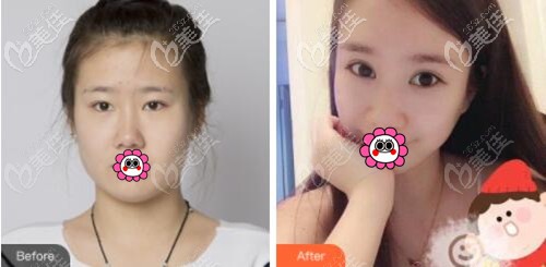 沈陽名流王莉莉割雙眼皮真人對比照