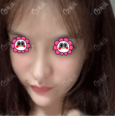 在北京蒂凡妮醫(yī)療美容做全臉脂肪填充有8天了