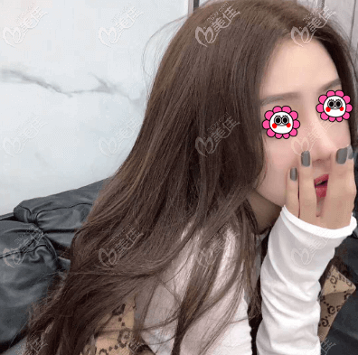 做面部脂肪填充塑形一個(gè)月