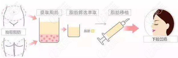 下眼瞼凹陷脂肪填充手術(shù)示意圖