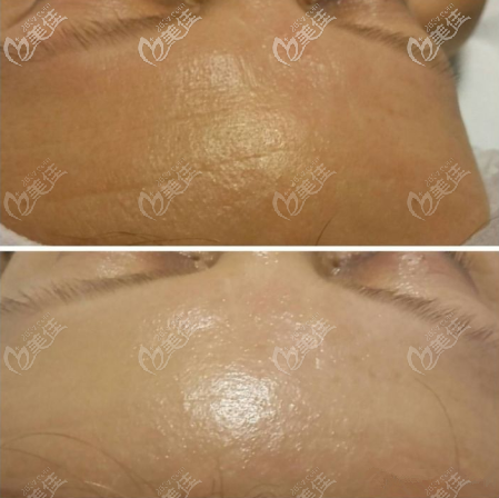 深藍(lán)射頻去抬頭紋效果