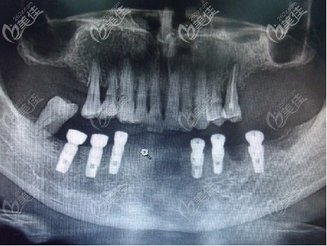老人牙齒ct情況 老人牙齒ct情況