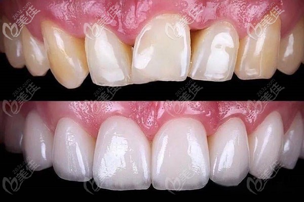 玻璃陶瓷貼面修復(fù)效果圖