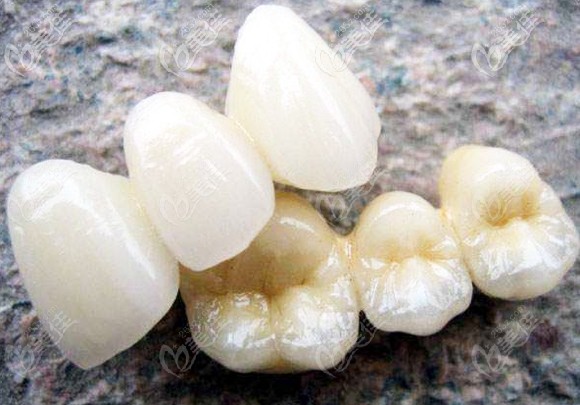 全瓷牙冠示意圖