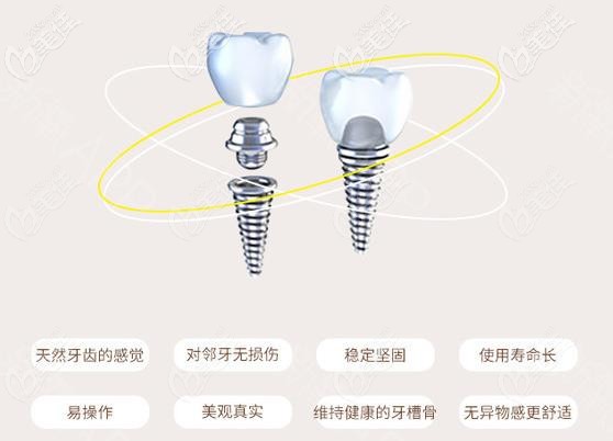 韓國登騰種植牙優(yōu)勢 韓國登騰種植牙優(yōu)勢