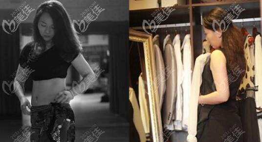 隆胸前胸部狀態(tài):產(chǎn)后乳房萎縮變形 隆胸前胸部狀態(tài):產(chǎn)后乳房萎縮變形