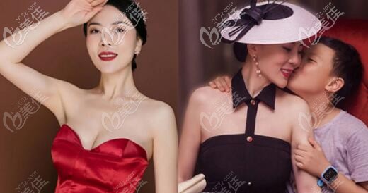 做完娜綺麗假體隆胸后的效果 做完娜綺麗假體隆胸后的效果