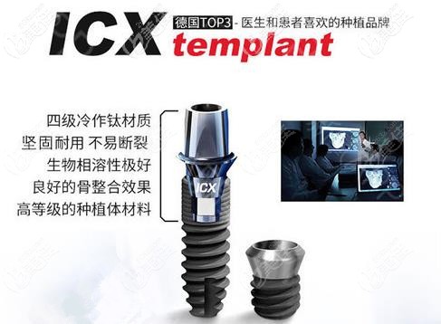 德國icx種植體 德國icx種植體