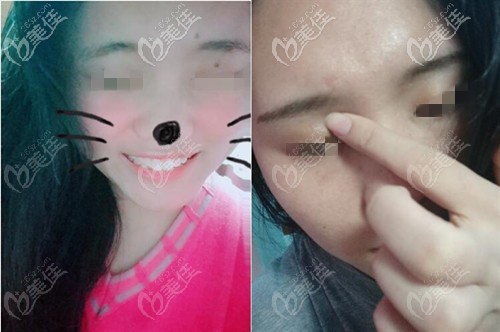 手術(shù)去痣三個(gè)月圖