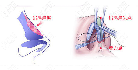 鄒進進隆鼻優(yōu)勢 鄒進進隆鼻優(yōu)勢