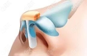 秦明燦做鼻子怎么樣 秦明燦做鼻子怎么樣