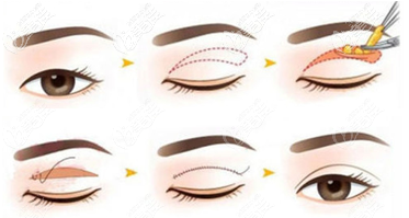 切開雙眼皮手術(shù)過程示意圖 切開雙眼皮手術(shù)過程示意圖