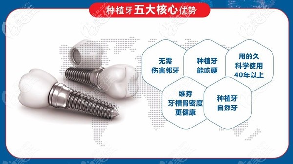 種植牙是恒信口腔的特色項目之一 種植牙是恒信口腔的特色項目之一