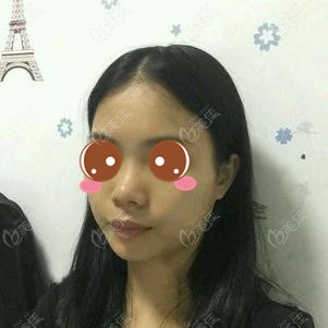 做玻尿酸隆鼻術(shù)前扁塌鼻 做玻尿酸隆鼻術(shù)前扁塌鼻