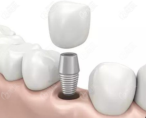 黃志斌醫(yī)生擅長的種植牙技術(shù)