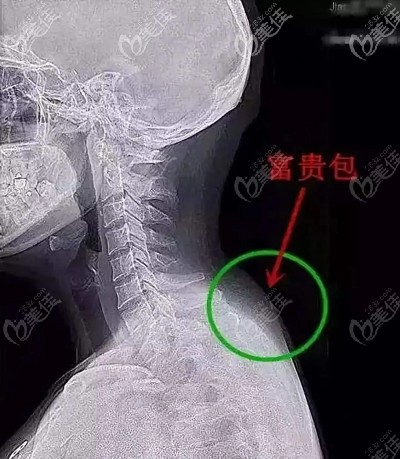 富貴包的形成原因