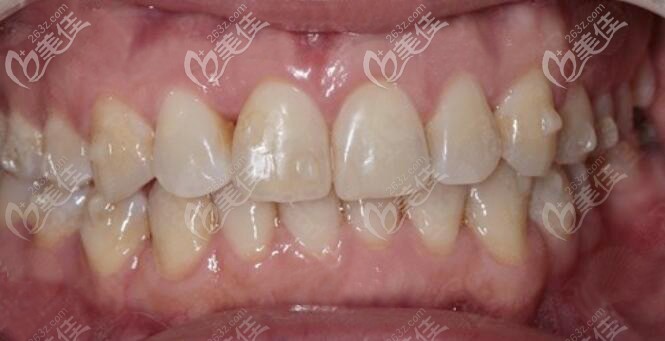 兩顆下門牙往里凹在東莞牙易美帶上時代天使牙套后，同事們都沒人看出來