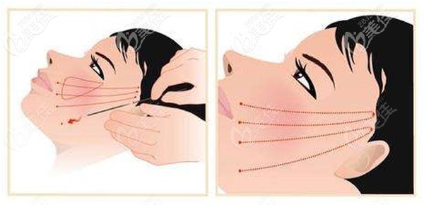 埋線提升手術(shù) 埋線提升手術(shù)