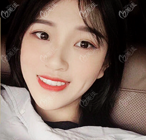 西安壹加壹口腔科正畸技術蠻好的,記錄我花三萬多元做隱適美矯正的效果