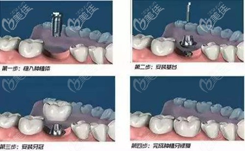 微創(chuàng)種植牙過(guò)程 微創(chuàng)種植牙過(guò)程