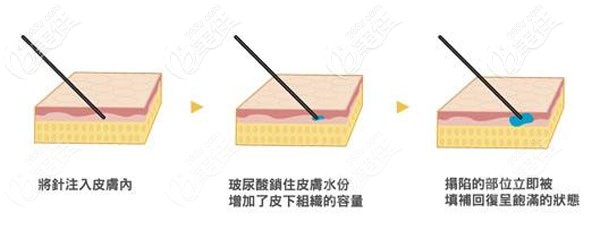 馬語嚀醫(yī)生注射技術(shù)優(yōu)勢(shì) 馬語嚀醫(yī)生注射技術(shù)優(yōu)勢(shì)