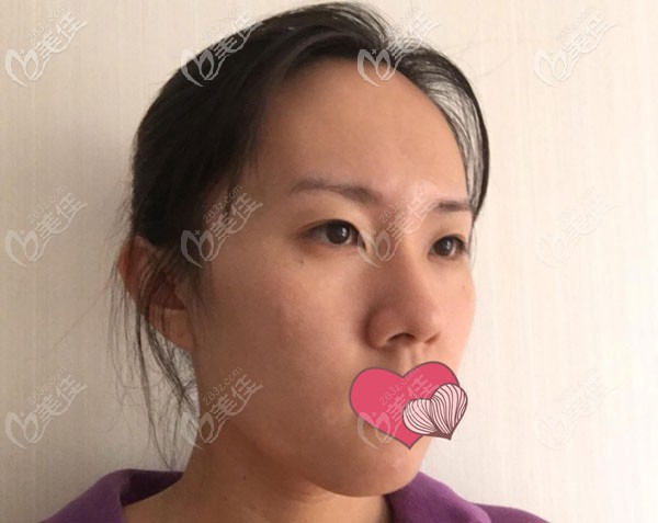 硅膠鼻第7天拆線，腫脹已經(jīng)拆線