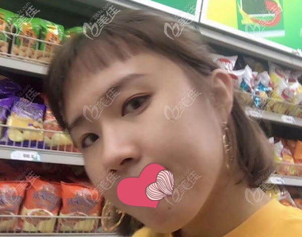 假體隆鼻一個(gè)月已經(jīng)定型