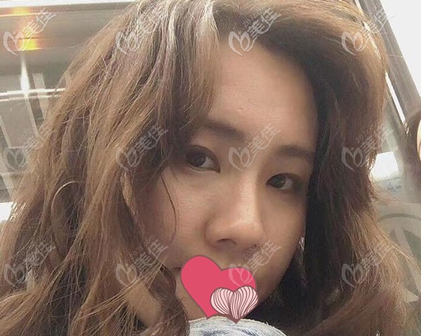 硅膠假體隆鼻2個(gè)月，鼻梁看起來更柔和了