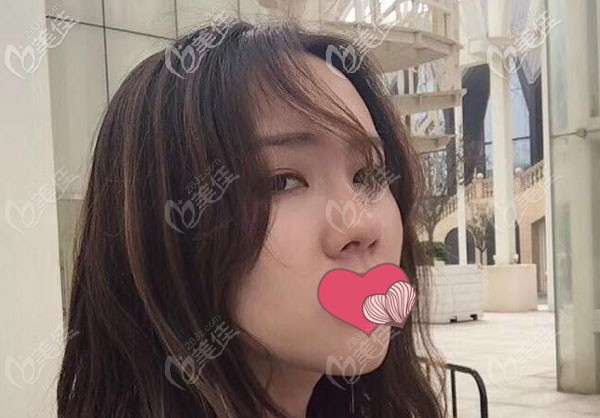 昆明吳氏嘉美韓國美迪菲硅膠隆鼻效果圖連載:我真后悔當(dāng)初鼻子打了玻尿酸