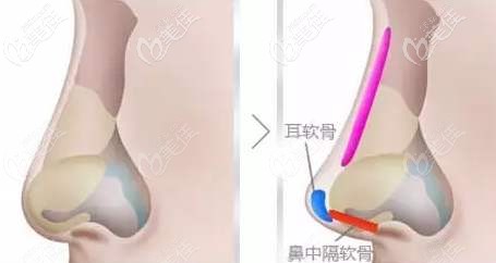 樊國友院長隆鼻手術風格