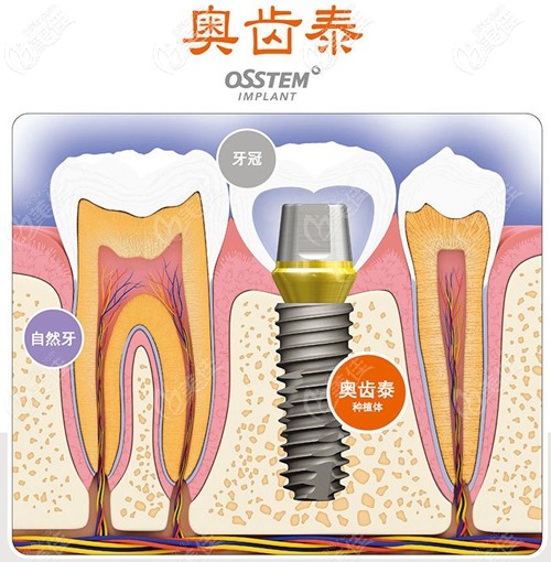 韓國(guó)奧齒泰種植系統(tǒng) 韓國(guó)奧齒泰種植系統(tǒng)