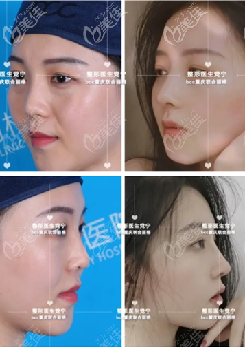 黨寧鼻綜合案例 黨寧鼻綜合案例