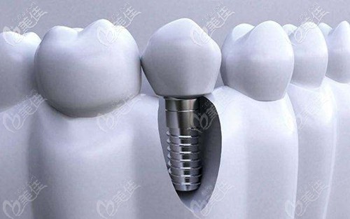 種植牙和真牙很相似 種植牙和真牙很相似