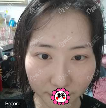 做面部吸脂前 做面部吸脂前