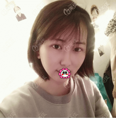 在北京蒂凡妮醫(yī)療美容做面部吸脂有7天了 在北京蒂凡妮醫(yī)療美容做面部吸脂有7天了