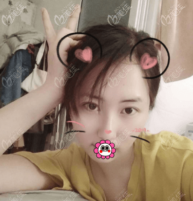 做面部抽脂半個多月樣子 做面部抽脂半個多月樣子