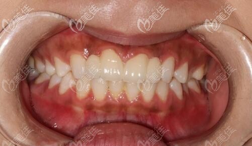 門牙縫隙大局部矯正關(guān)閉間隙又戴了全瓷牙，點(diǎn)贊樂山安普口腔的效率